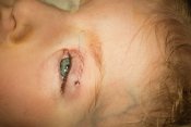 14.3.2018 - Speciální implantáty zachraňují nedovírající oční víčka
