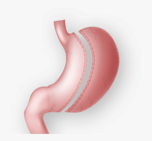 gastric-sleeve