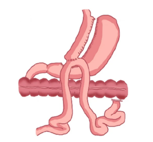 OAGB – One Anastomosis Gastrický bypass