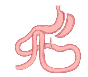 SASJ -single anastomosis sleeve jenunal