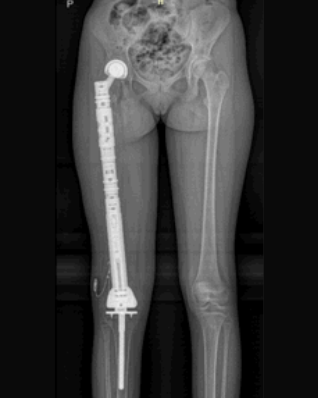 Rostoucí endoprotéza