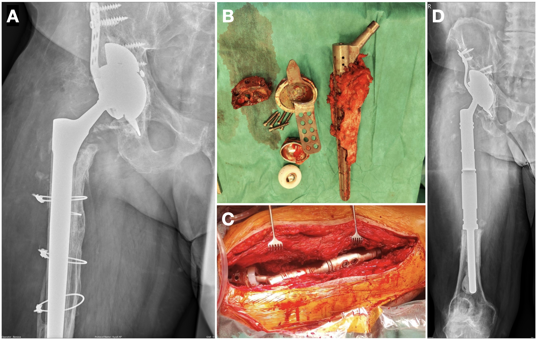 modulární megaprotéza