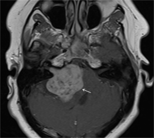 vestibular schwannoma