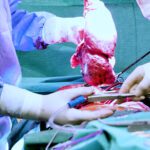 Lung transplantation - operating room