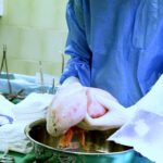 Transplantace plic - operační sál